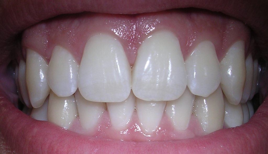 The Dental Crowns N