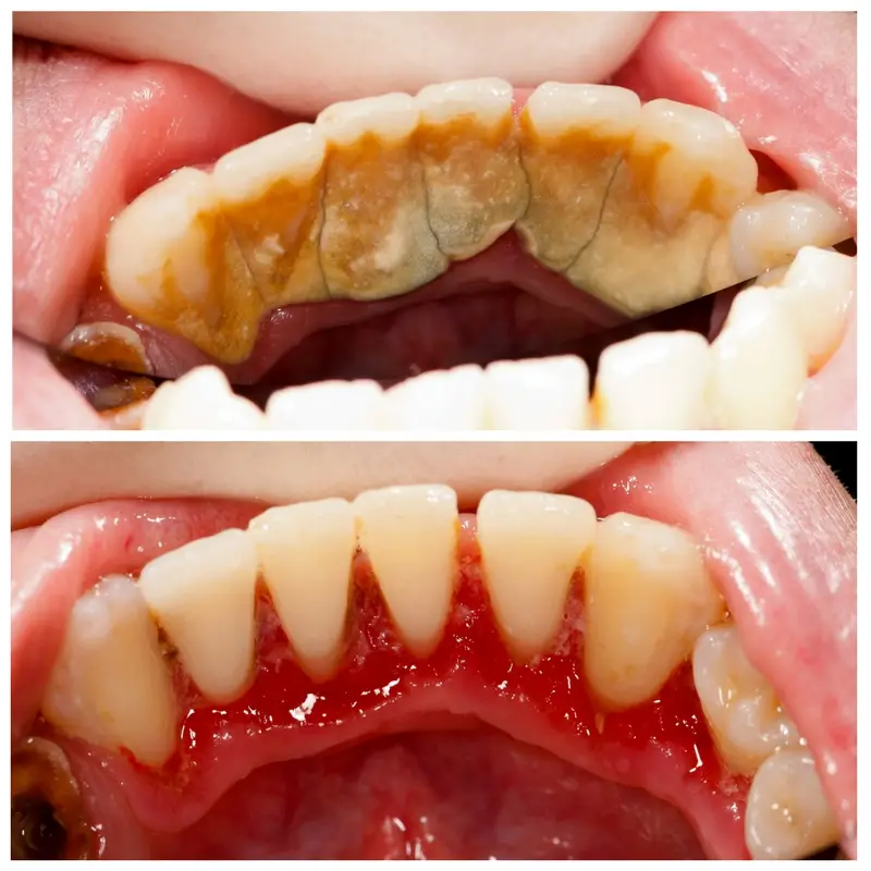 The Dental Crowns dental cleaning in noida
