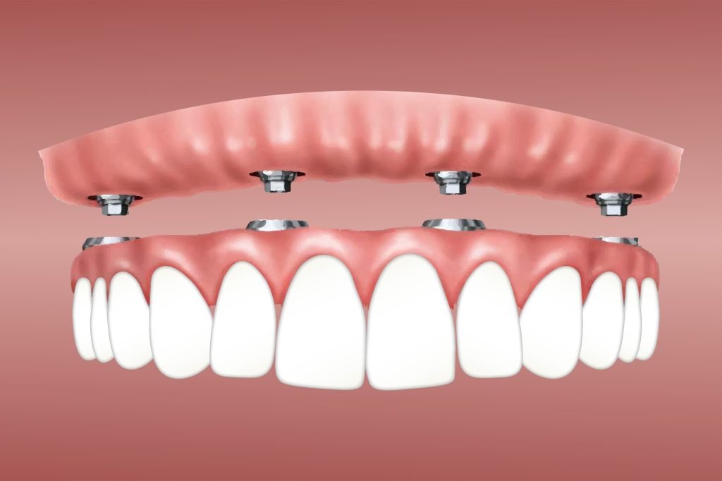 dental implant in noida