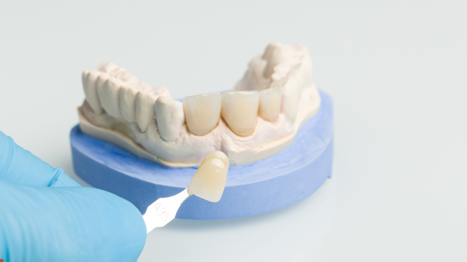 The Dental Crowns Dental implants