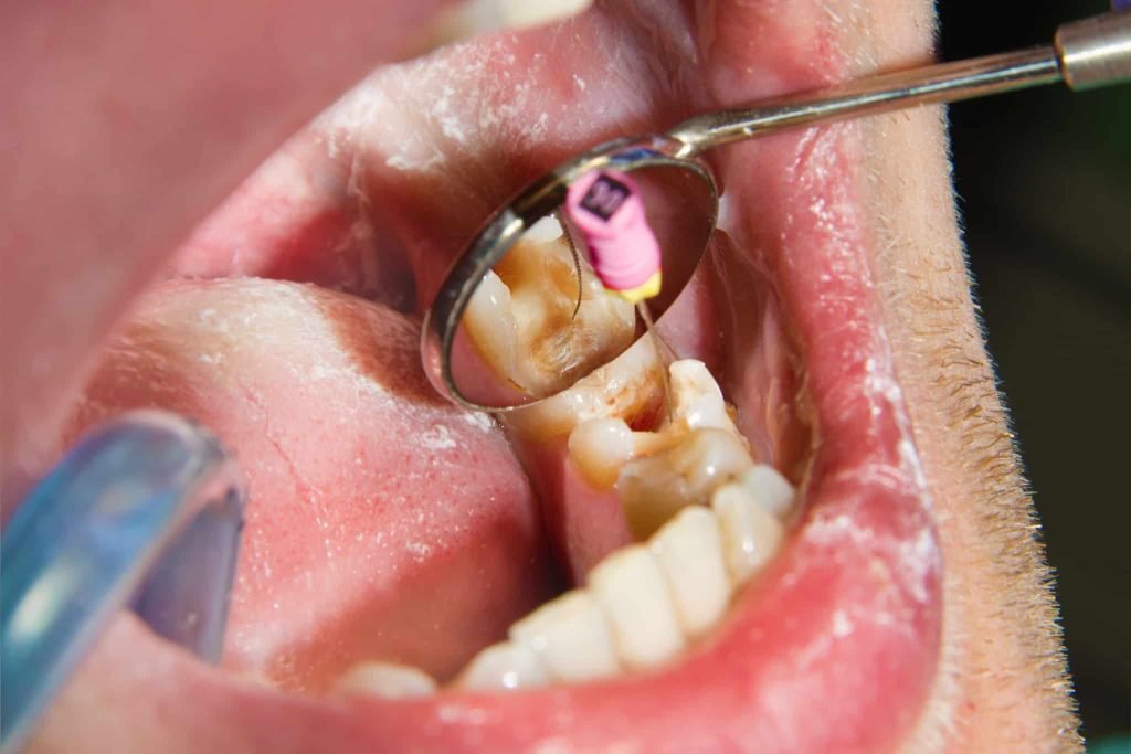 painless root canal treatment in Noida