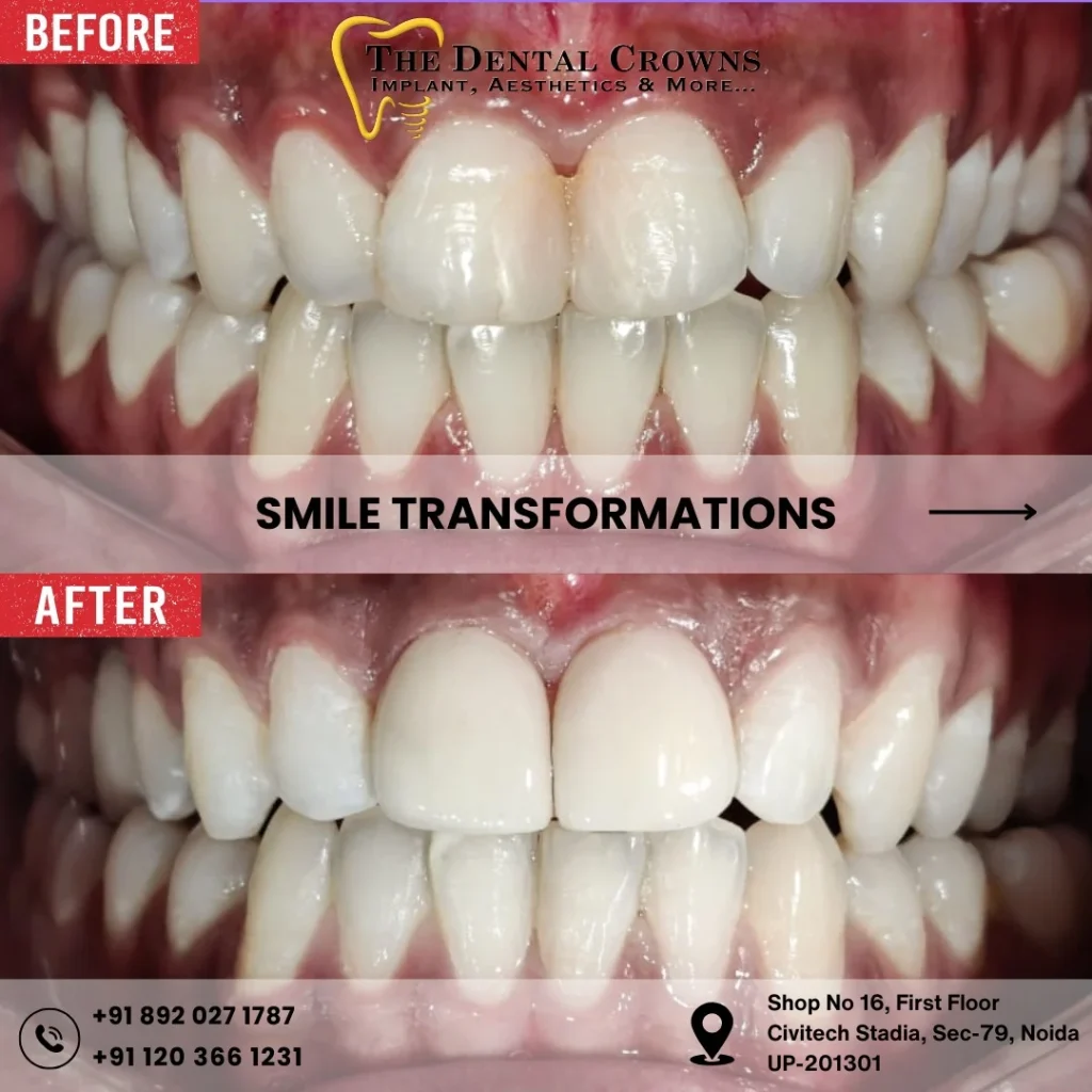 Smile makeover in Noida at The Dental Crowns clinic