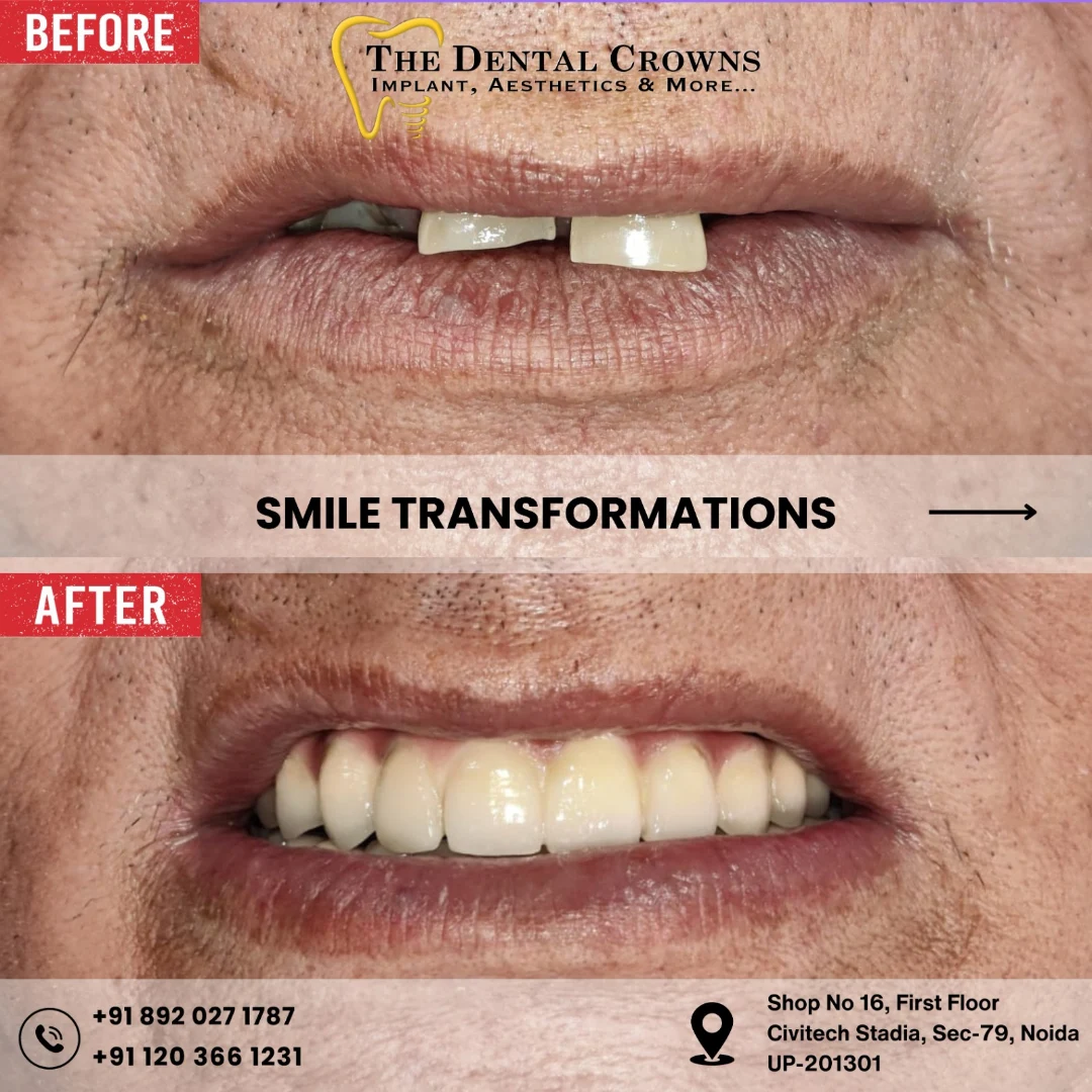 The Dental Crowns Composite Filling in Noida