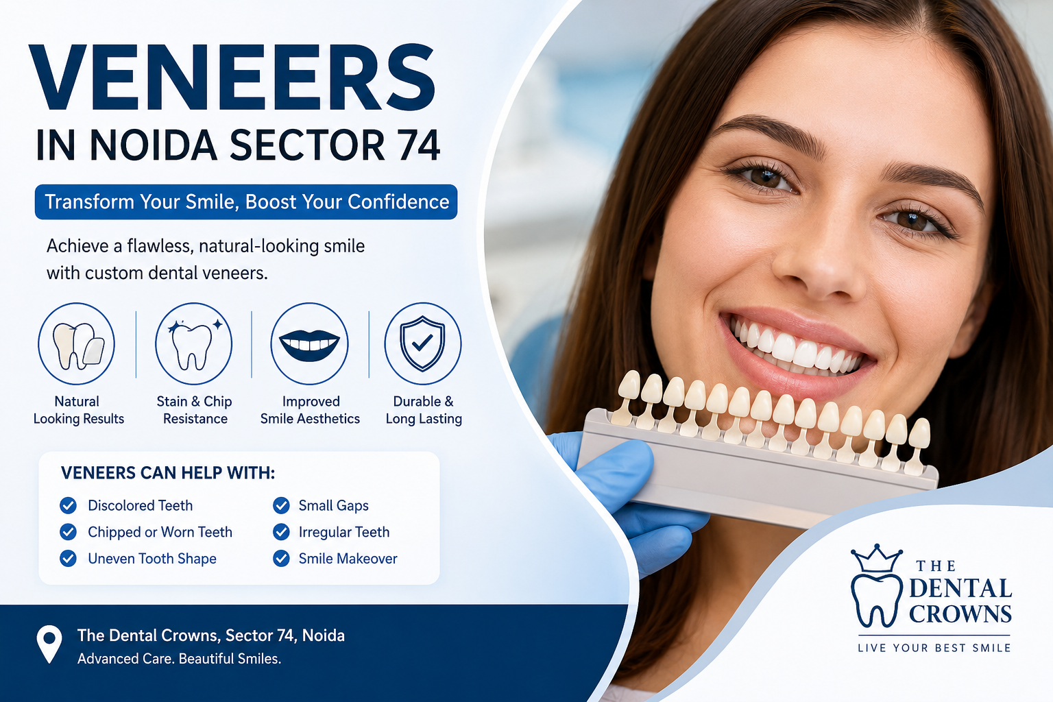veneers in Noida