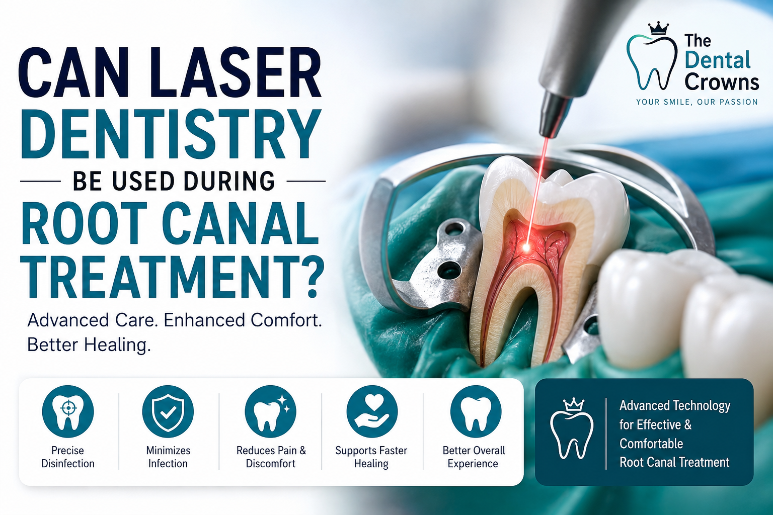 Can Laser Dentistry Be Used During Root Canal Treatment?