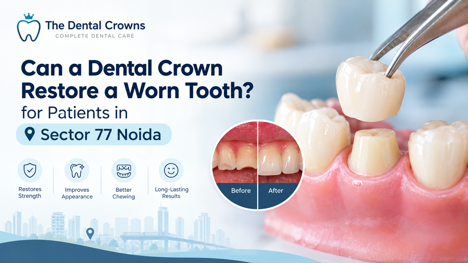 Can a Dental Crown Restore a Worn Tooth for Patients in Sector 77 Noida?